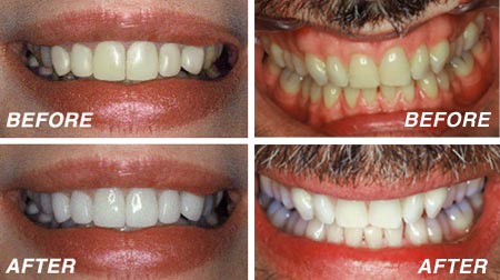 whiter image teeth whitening kit